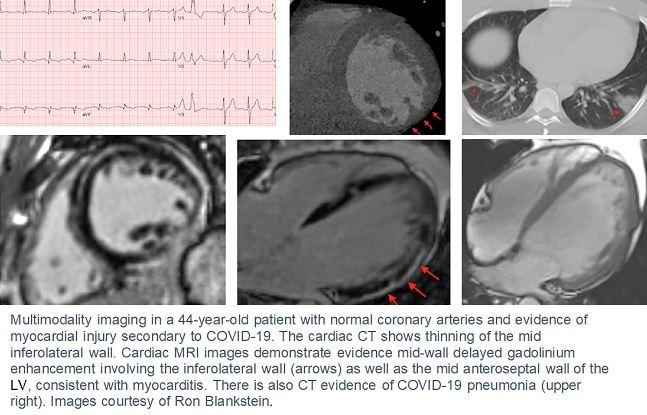 Which Modality and When? New Guidance for Cardiac Imaging in COVID-19 